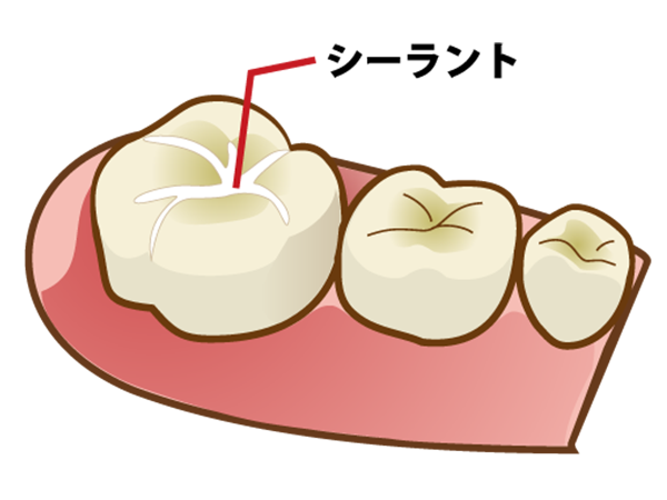 シーラント（歯の溝埋め）
